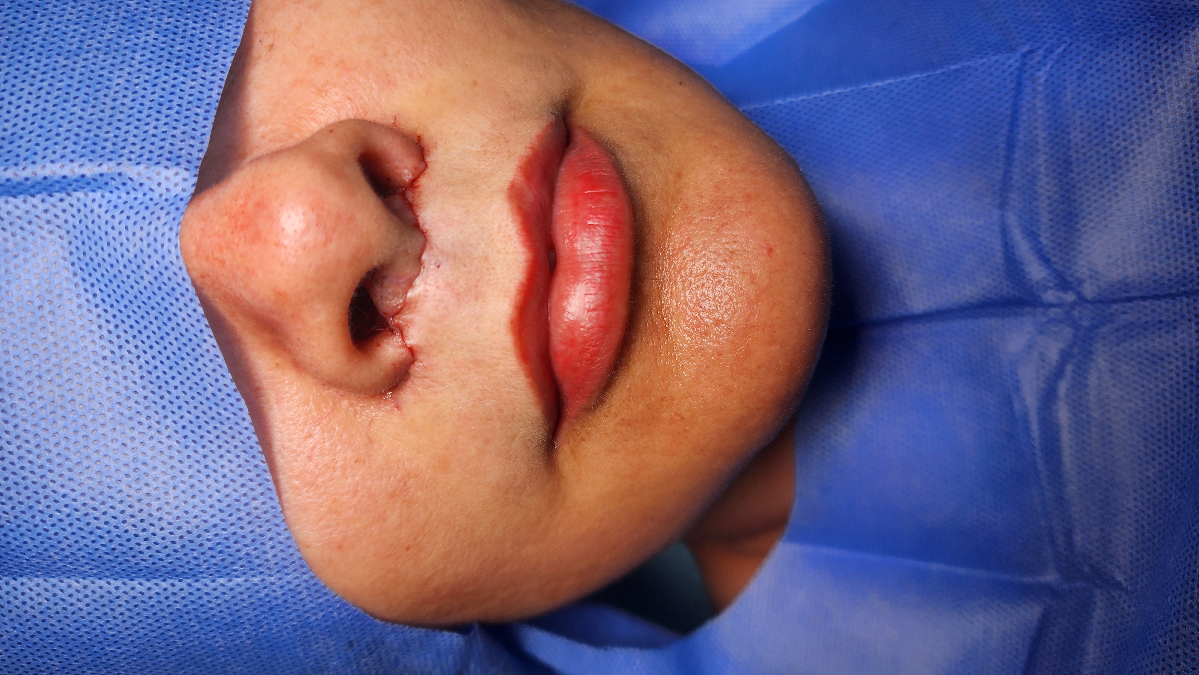 Lip Lift