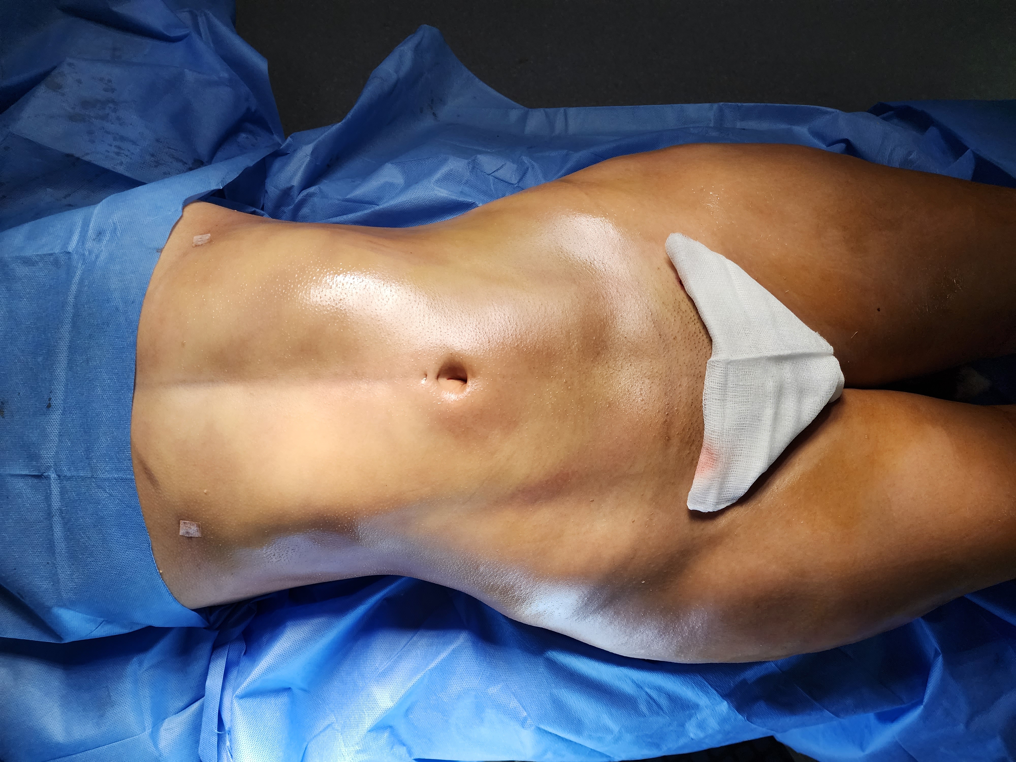 Lipoescultura 360°