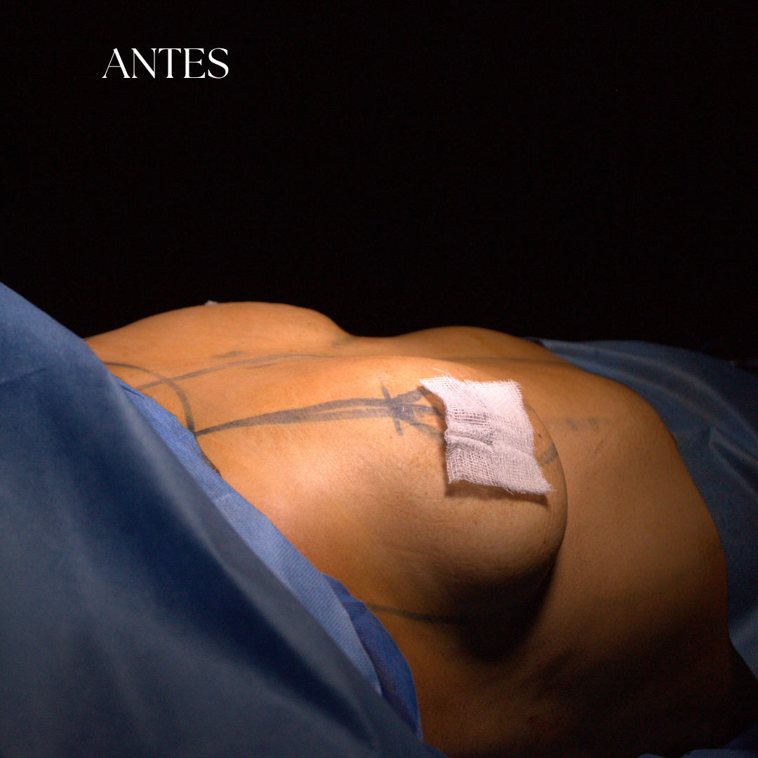 ANTES